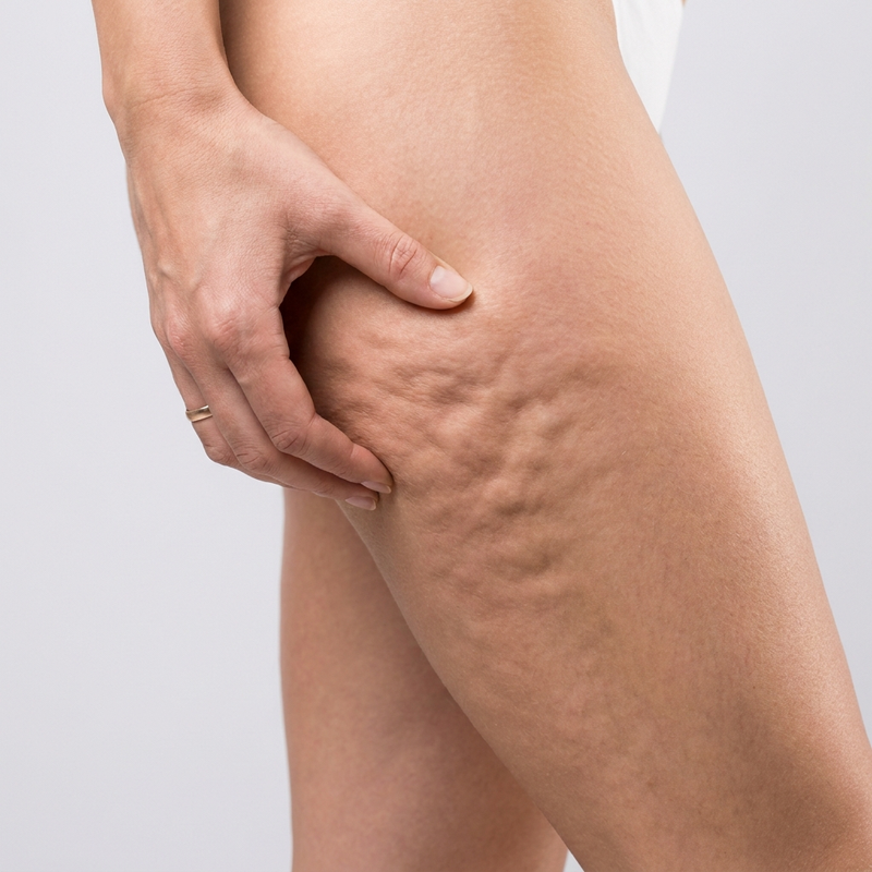 REASON 1: CELLULITE IS NOT A FAT PROBLEM