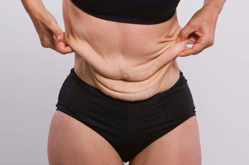 Reason 1: Loose Skin Is Not Extra Skin